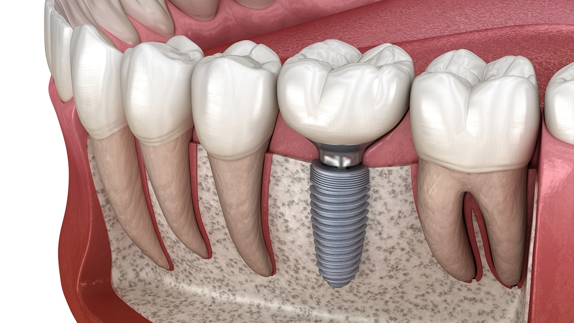 Dental implants mission viejo